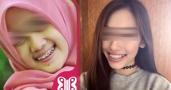 Ngeri Mulut Gadis Cantik Ini Jadi Begini Gara Gara Pasang Behel Gigi