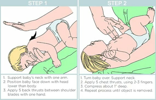 Orang Yg Tersedak Makan Ayam Ga Akan Meninggal Klo Kita Mengenal Heimlich Manuver