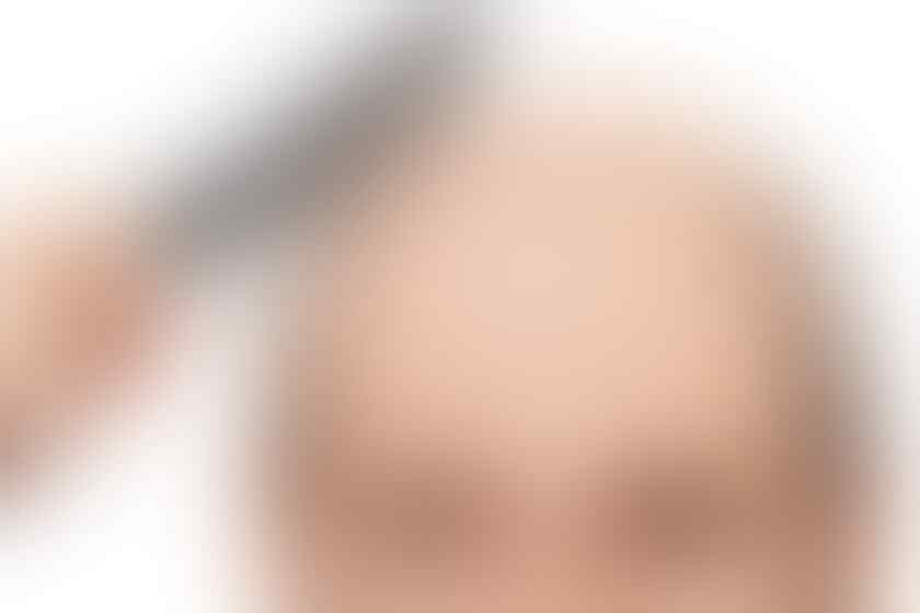 Alasan Harus Menggunakan Nisim Sebagai Solusi Atasi Kerontokan dan Kebotakan