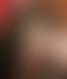 10 Wajah Buruk Akibat Gagal Operasi Plastik