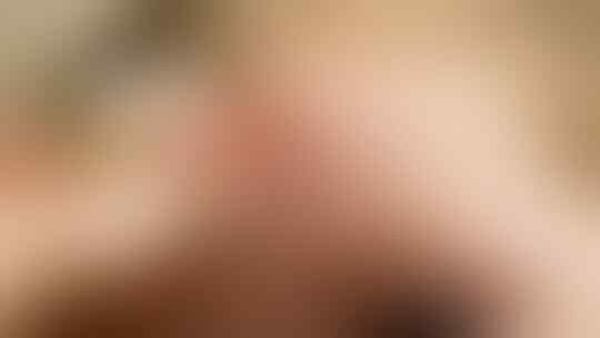 Semua Harus Tahu! Lakukan Langkah Ini Bila Mengalami Luka Robek