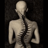 scoliosis