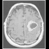 glioblastoma