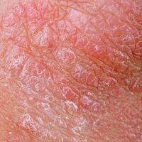 kelainan-bawaan-berupa-sisik-pada-kulit