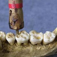 alat-kedokteran-gigi-jaman-dahulu