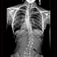 semangat-hidup-seorang-iin-nur-indah-peserta-x-factor-indonesia