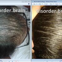 helprambut-gua-rontok-hampir-botak-2