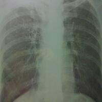 ask-your-pulmonologist---ruang-diskusi-penyakit-paru-dan-saluran-pernafasan