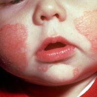 sharing-alergi-kulit-muka-bayi-eczema-ruam-susu-atopic-dermatitis-by-mungsiji
