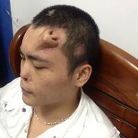 pria-ini-punya-hidung-di-dahi