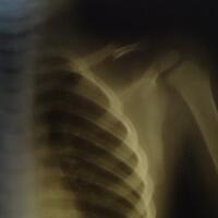 tanya-jawab-patah-keropos-pengapuran-tulang-cedera-olahraga-dll