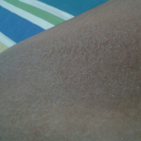 ask-kulit-gatal-dan-bercak-hitam