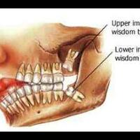 info-jenis-gigi-berlubang-sakit-gigi-atau-tidak-merapat