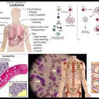 sedikit-hal-tentang-leukemia