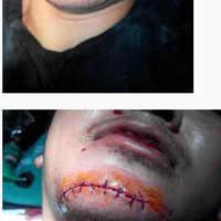 terimakasih-semualuka-robek-ane-didagu-di-fly-over-akibat-benang-sembuh-total