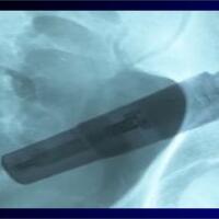 kecelakaan-aneh-vibrator-terjebak-di-usus-besar