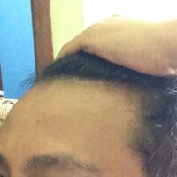 helprambut-gua-rontok-hampir-botak-2---part-1