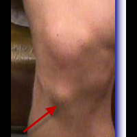 gan-tanya-penyakit-osgoodschlatters-tolong-nih