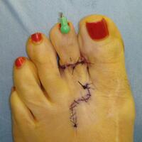 gokil-demi-cantik-jari-kaki-pun-di-potong