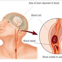 tips-menangani-stroke-alami-tanpa-obat