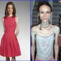 mengerikan-alami-anoreksia-tubuh-mereka-kurus-tinggal-tulang-belulang
