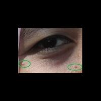 free-skin-consultation--discussion-jerawat-flex-kerutan-kusam-vit-c-inj-dll