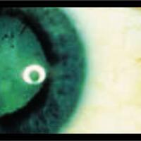 makin-muda-penderita-katarak-gara-gara-gadget