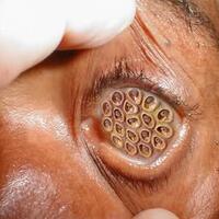 tes-trypophobia-disini-gan