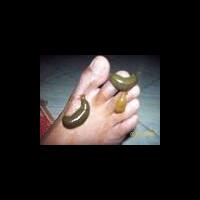 terapi-pengobatan-paling-quotgilaquot-di-seluruh-dunia