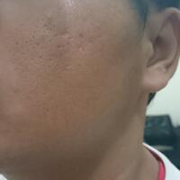 free-skin-consultation--discussion-jerawat-flex-kerutan-kusam-vit-c-inj-dll