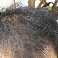 helprambut-gua-rontok-hampir-botak-2---part-1