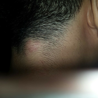 ask-gan-ini-penyakit-apa-ya-uda-2-tahun-stgh-katannya-lipoma