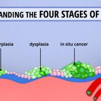 mengenal-lebih-dekat-tentang-kanker
