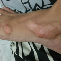 ask-tentang-keloid