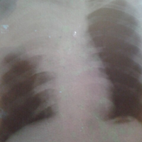 perlu-banget-memahami-penyakit-tuberculosis-paru-tbc-paru