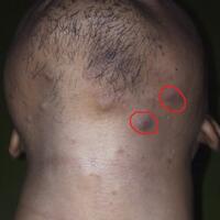 free-skin-consultation--discussion-jerawat-flex-kerutan-kusam-vit-c-inj-dll