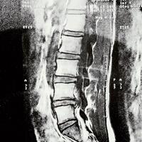 mengenal-syaraf-kejepit---hnp--hernia-nucleus-pulposus