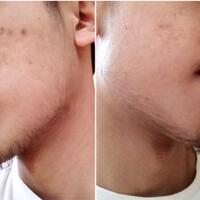 group-brewok-quotbrengozerquot-forum-resmi-berbagi-informasi-progress-hair-facial