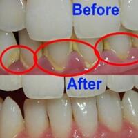 inilah-trik-rontokkan-karang-gigi-hanya-dalam-hitungan-detik