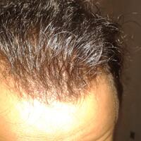 helprambut-gua-rontok-hampir-botak-2---part-1