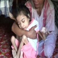 berat-badan-bocah-berusia-13-tahun-asal-pinrang-ini-hanya-5-kilogram