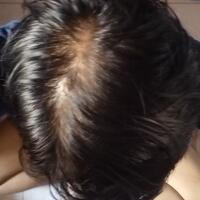 helprambut-gua-rontok-hampir-botak-2---part-1