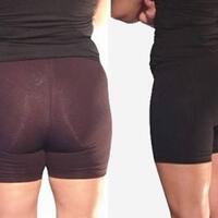 penyakit-terditeksi-dari-bentuk-bokong