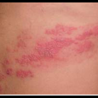 lombapengalaman-ngobatin-herpes-jampes-pake-bawah-putih-berbusa