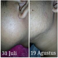 group-brewok-quotbrengozerquot-forum-resmi-berbagi-informasi-progress-hair-facial