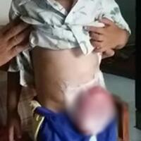 ditolak-rumah-sakit-usus-bocah-ini-sudah-6-bulan-dibungkus-plastik-makanan