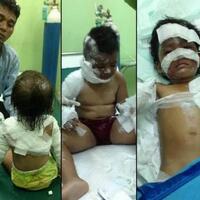 empat-balita-korban-bom-di-gereja-alami-luka-bakar-sekujur-tubuh