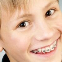 boleh-tidak-anak-pasang-kawat-gigi-ini-penjelasan-ahli