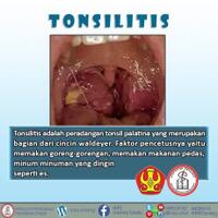 hmpd-untad---tonsilitis