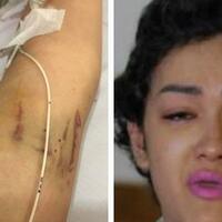 tak-kunjung-sembuh-jupe-menyesal-pernah-sedot-lemak